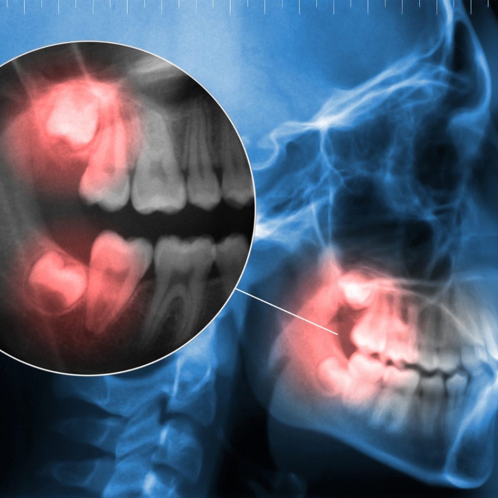 X-ray image of a human jaw highlighting impacted wisdom teeth in the lower and upper jaws with a red overlay, emphasizing areas of potential pain or inflammation -Dental Park