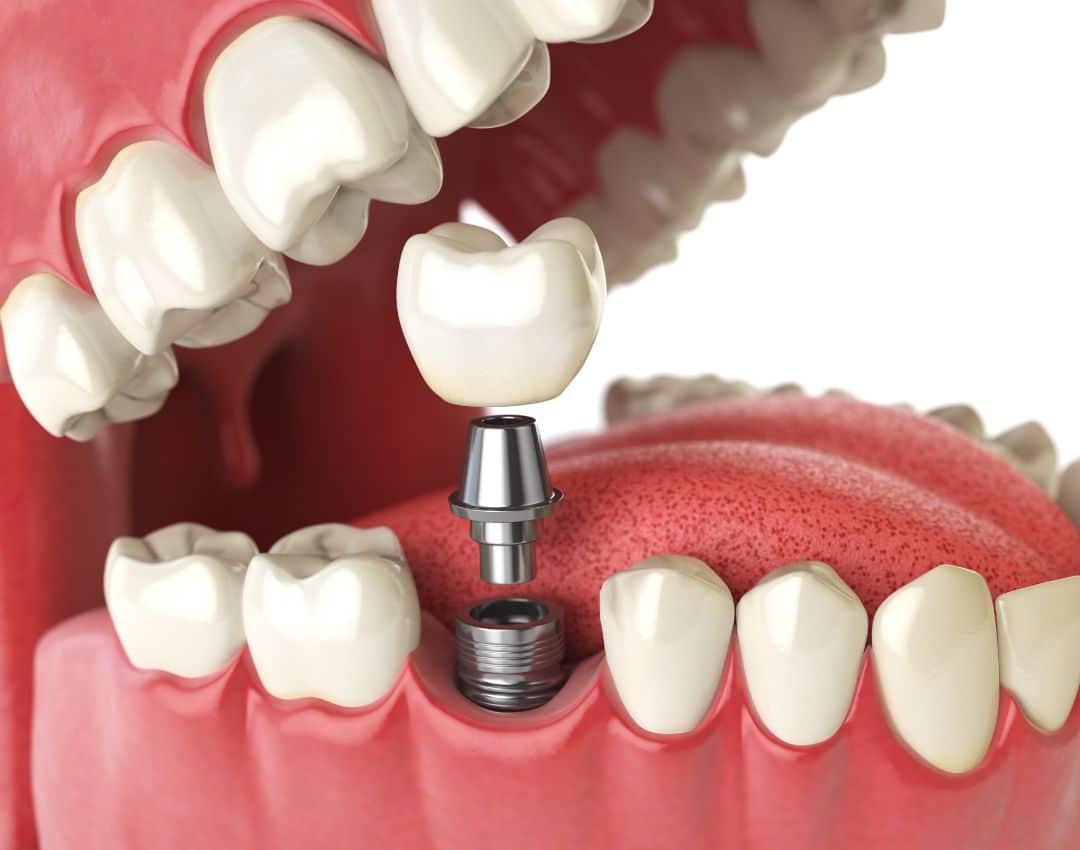 Illustrasjon av tannimplantat som monteres i underkjeven, med kunstig tannkrone, abutment og implantatskrue. 3D-modell av tannbehandling og implantatkirurgi.