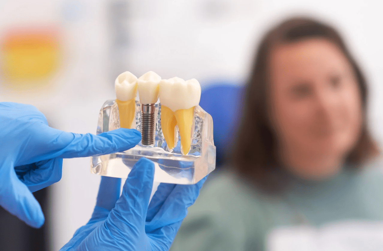 Nærbilde av tannimplantat-modell som vises til pasient av person med blå hansker. Forklaring av tannimplantatprosess under konsultasjon.
